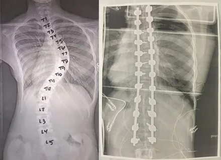 My Daughter had scoliosis surgery. - Imgur