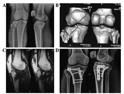 MDCT and MRI for the diagnosis of complex fractures of the t