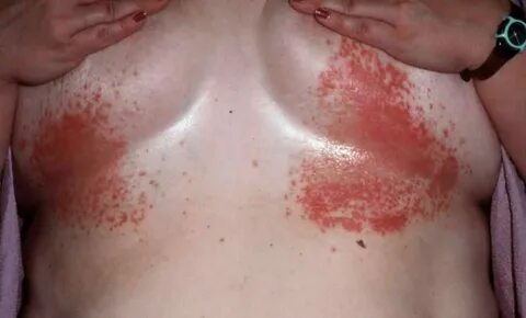 Under boob rash look like achne