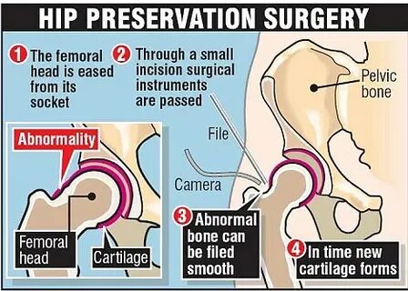 Murray's hip surgery : The experts' opinion Page 2 Talk Tenn