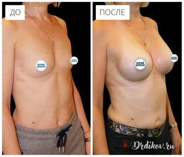 What do boob implants look like