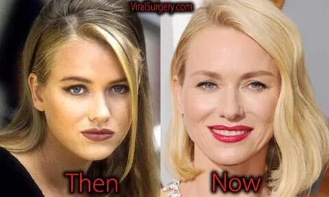 Naomi Watts Plastic Surgery: Before and After Botox, Nose Jo