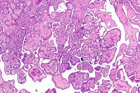 File:Well-differentiated papillary mesothelioma -- low mag.j