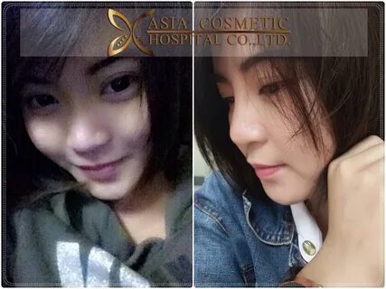 Rhinoplasty Before and After at Asia Cosmetic Hospital