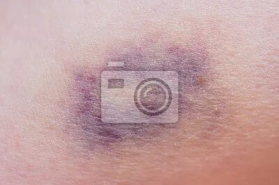 Makroaufnahme von lila blauen flecken auf der haut. fototape