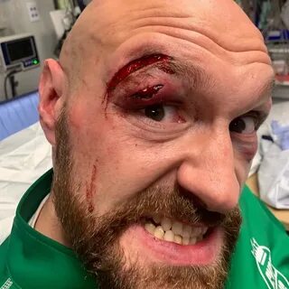 Tyson Fury had 40 stitches then went for a beer and won £ 5k