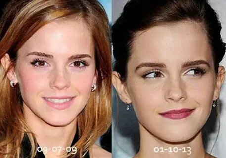 Emma Watson Plastic Surgery - Plastic Industry In The World