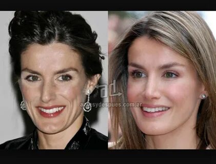 Enhanced Beauty: Celebrity & Royal Noses - The Bag Hag Diari