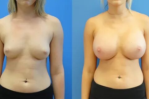 Before After Boob Job Nude