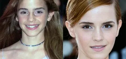 Emma Watson Nose Job - Emma Watson Before and After Plastic 