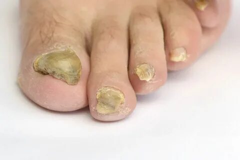 The Best Fungal Toe Nail Treatment - Taylors Lakes Podiatry 