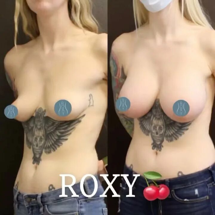 ...roxyplasticsurgery) в Instagram: «📸 Before & 6 months After Bre...