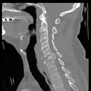 Cervical vertebral body burst fracture with retropulsed frag