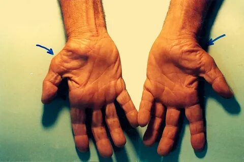Carpal Tunnel Syndrome Article