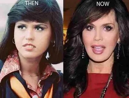 Marie Osmond Plastic Surgery