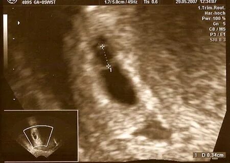 Schwangerschaft 6. Woche (6. SSW) Ultraschallbilder