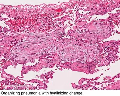 Bronchiolitis Obliterans Organizing Pneumonia 10 Images - Br