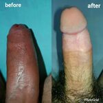 File:01Penis before and after circumcision.jpg - Wikimedia C