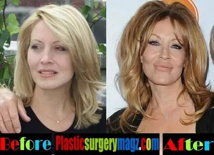 Linda Kozlowski Plastic Surgery Before and After Plastic Sur