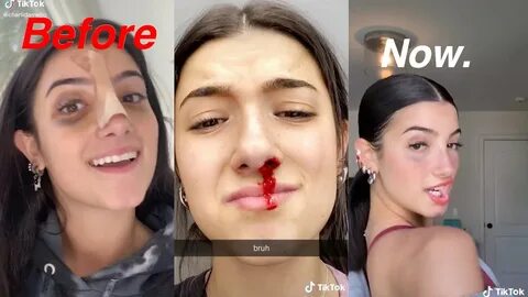 Charli damelio nose job check full tiktok DELETED VIDEO - Yo