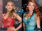 Blake Lively Plastic Surgery and Breast Implants Bad Plastic
