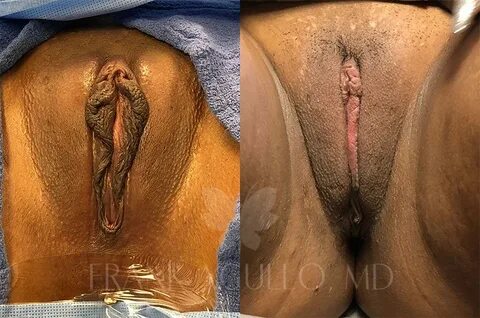 Before & After Labiaplasty Photos - Frank Agullo, MD