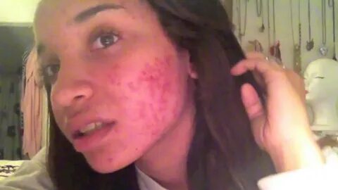 My Acne Journey 2012-13 (Severe Cystic Acne) RAVEN ELYSE - Y