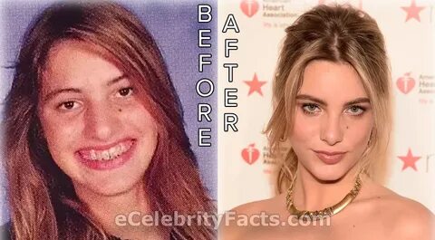 Lele Pons has admitted to undergoing plastic surgery Plastic