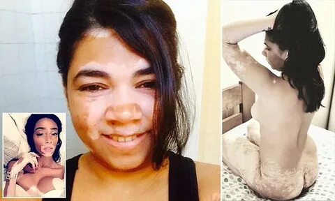 New Zealand woman with vitiligo poses NAKED to celebrate her