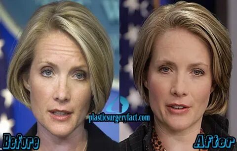 Dana Perino Archives - Plastic Surgery Facts