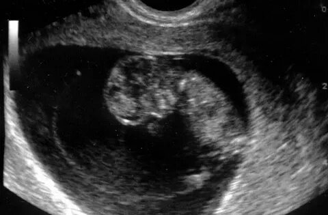 Normal 10 week baby ultrasound.