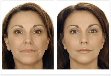 Injectables Before & After Pictures - Injector 5280
