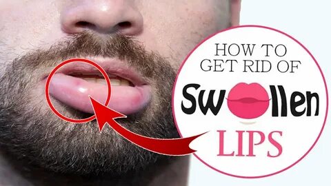 How to Treat Swollen Lips Naturally at Home Home Remedies fo