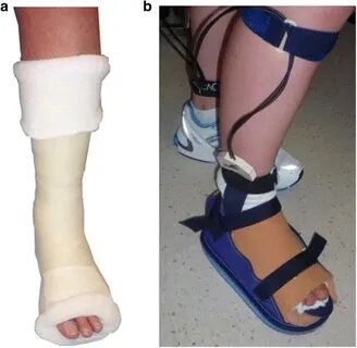 Figure 1 Total contact cast wall load in patients with a pla
