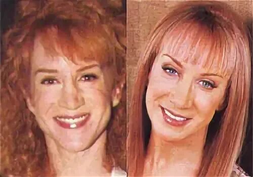 Kathy Griffin Plastic Surgery