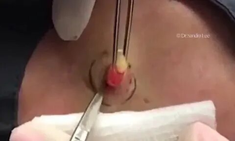 Yellow fatty lump bursts out of a man's arm as a doctor cuts