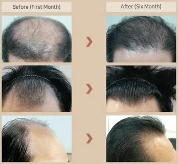 WELO - HAIR BOOM - Treat to androgenetic alopecia and promot