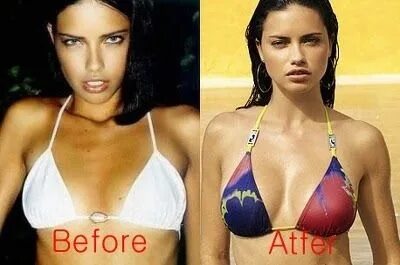 Breast augmentation - Celebrities plastic surgery - About sp