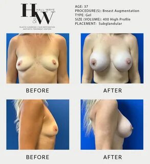 Breast Augmentation - Hall & Wrye - Plastic Surgery and Medical Spa in Reno NV, 