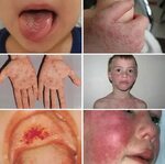 Инфекционный мононуклеоз у детей: виды, причины, симптомы, д