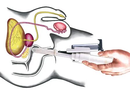 Transrektaler Ultraschall (TRUS) Prostata.de