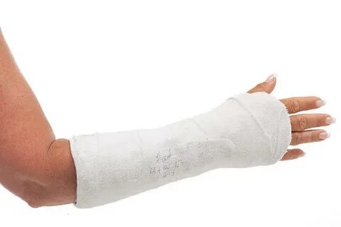 Arm In Cast - Сток картинки - iStock