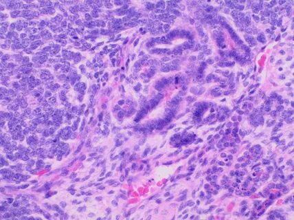 File:Histopathology of Wilms' tumor, original.jpg - Wikimedi