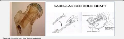 PDF Recent Concept for Management of Femoral Neck Fracture N