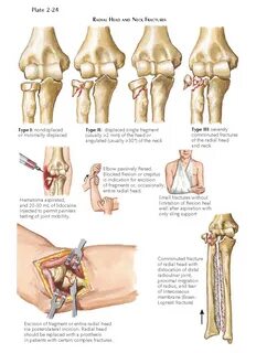 FRACTURE OF HEAD AND NECK OF RADIUS - pediagenosis