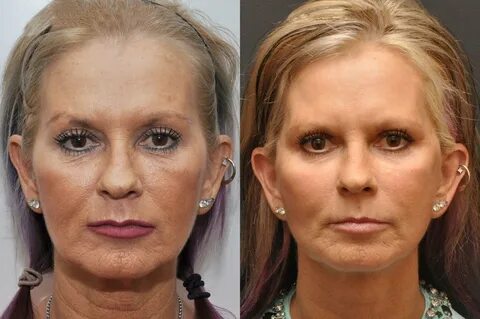 Facial plastic surgery before and after - Plastic Surgery