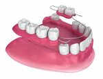 Removable Partial Denture - Фото база