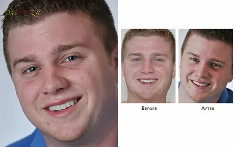 How To Fix Two Crooked Teeth Without Braces - United Blog