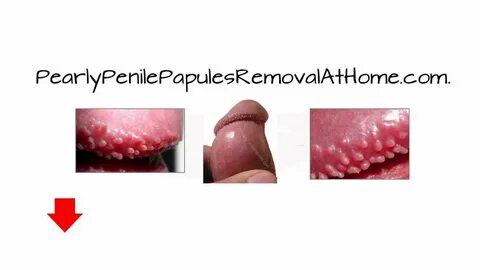 PPP Treatment - Best Treatment For Pearly Penile Papules - Y
