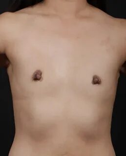 Breast Augmentation - Round Implants Dr Gavin Sandercoe